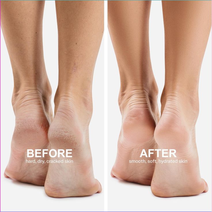 Peeldo Exfoliating Foot Mask Hydrating Sock